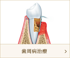 歯周病治療