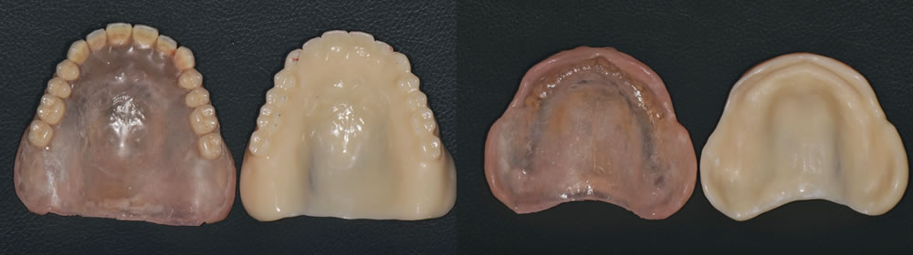 治療用義歯とデジタル義歯との比較