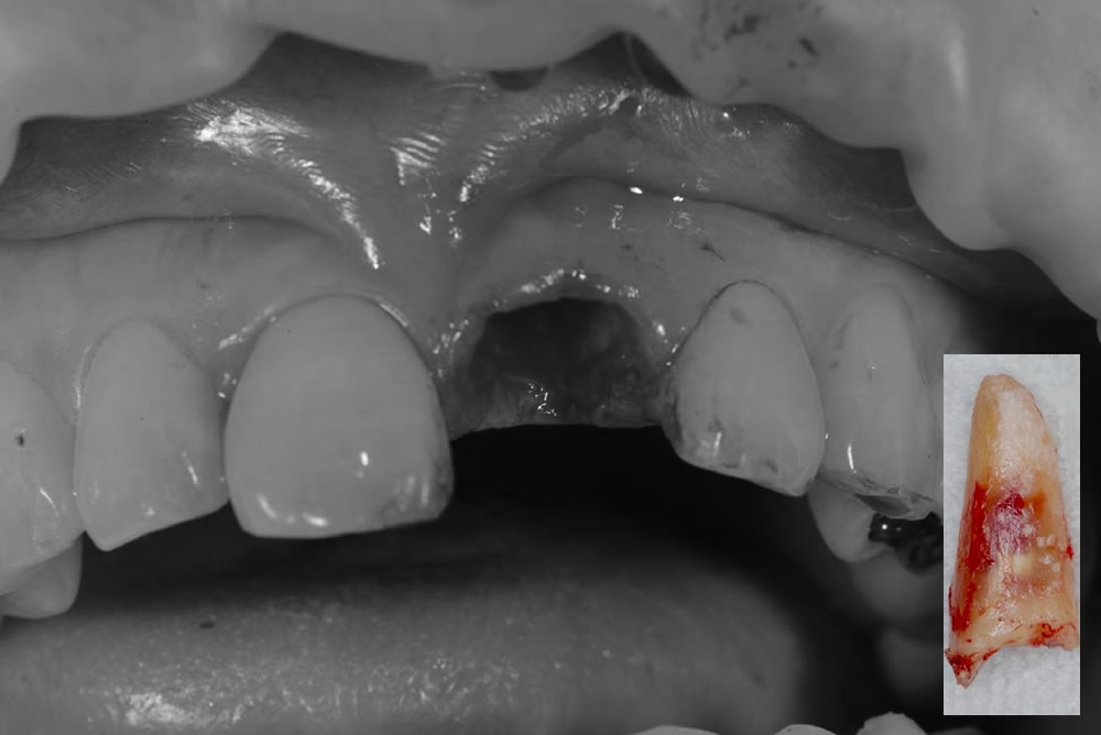歯根破折歯の抜歯