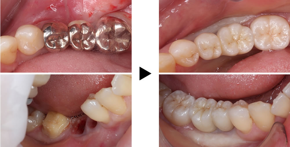 インプラントの症例