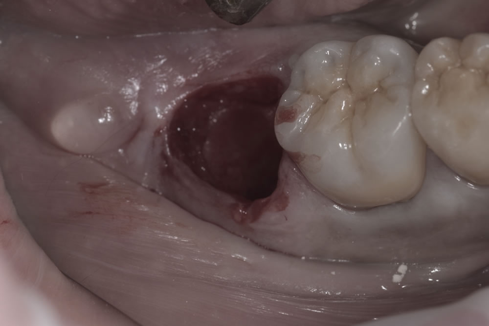 破折歯の抜歯