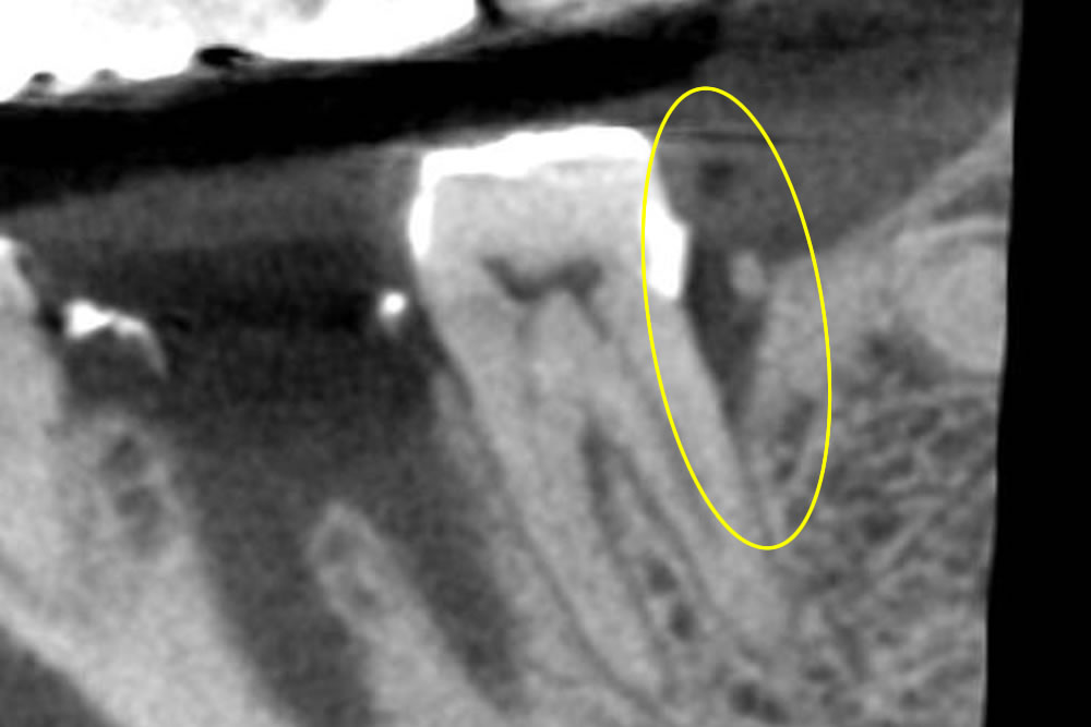 奥歯の骨吸収