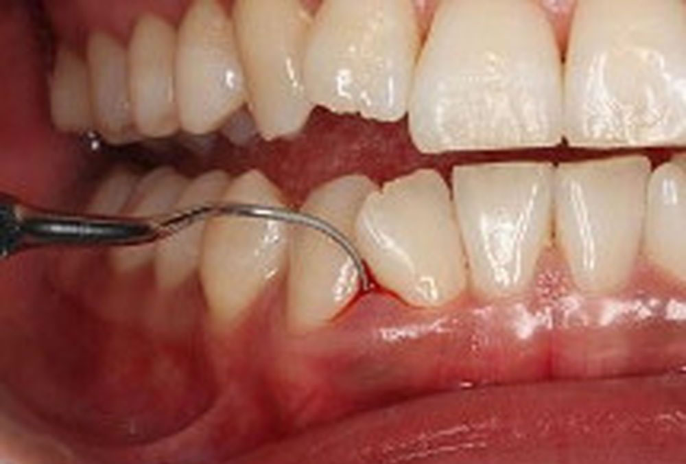 歯周病組織検査
