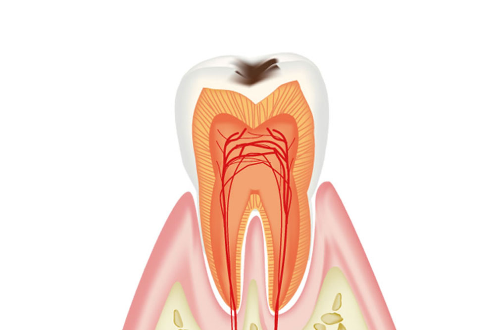 虫歯・歯周病