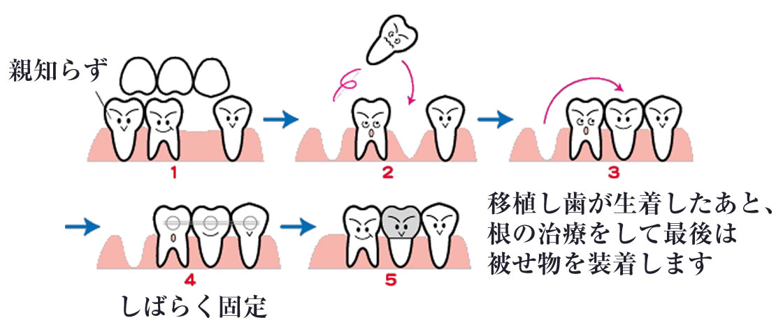 親知らずの移植(歯牙移植)