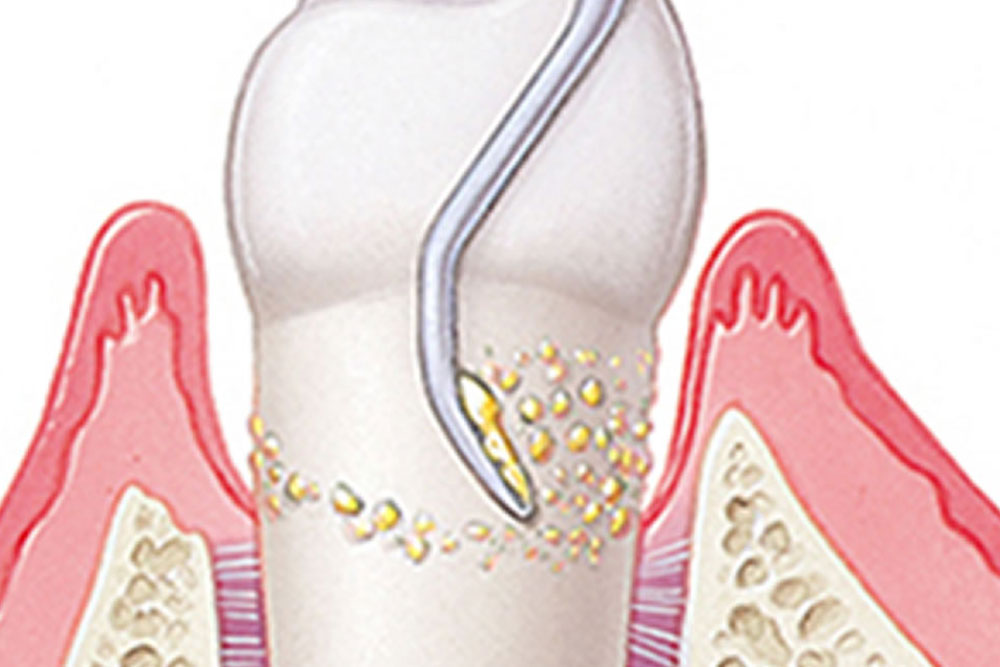 歯周炎