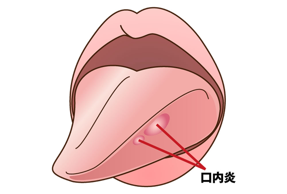 口内炎