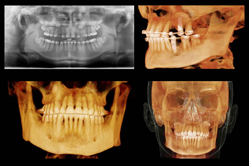 歯科用CT